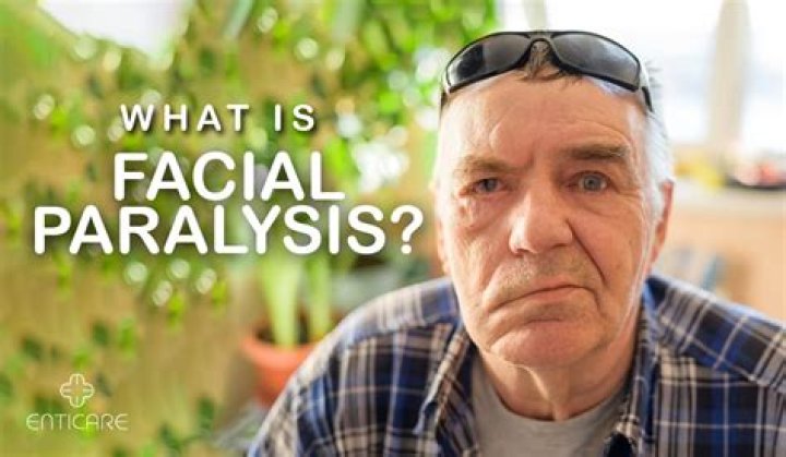 What is facial paralysis?