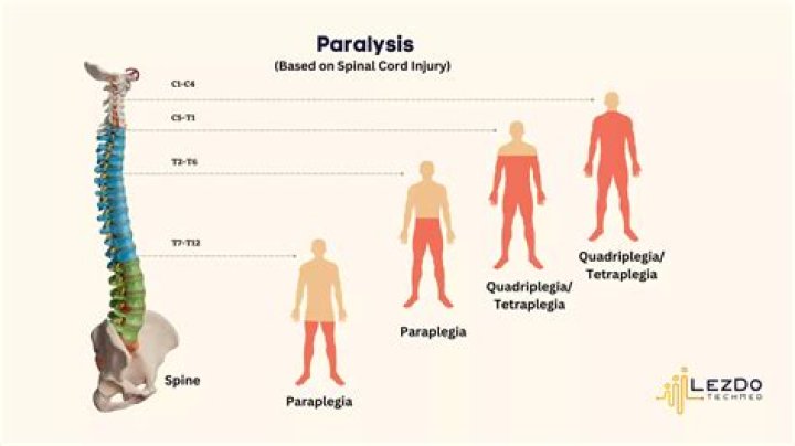 What is functional paraparesis?