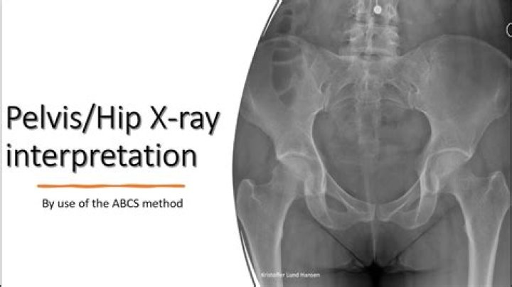 What is pvns of the hip?