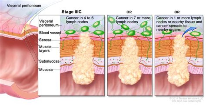 What is rectosigmoid cancer?