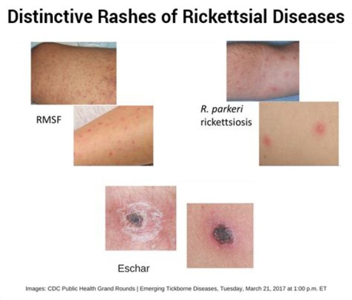 What is rickettsial infection?