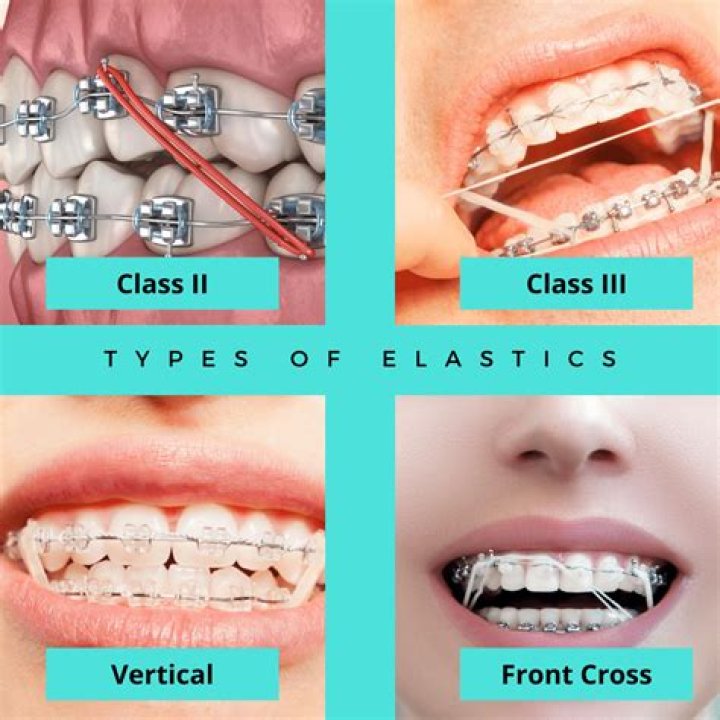 What is the meaning of interarch?