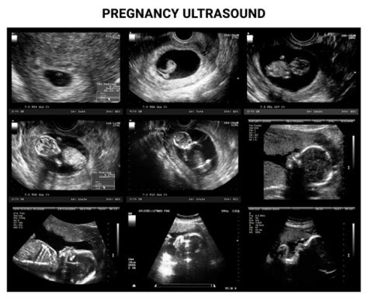 What is ultrasonography for pregnancy?