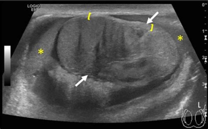 Whats a testicle tear?