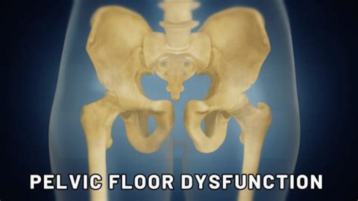 Whats pelvic floor dysfunction?