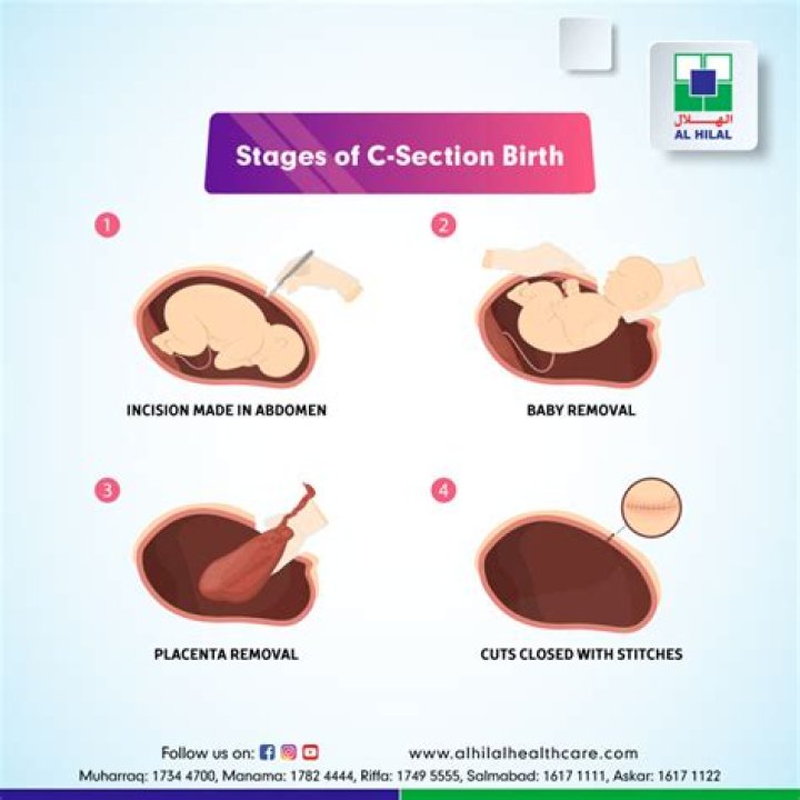 When are cesareans performed?