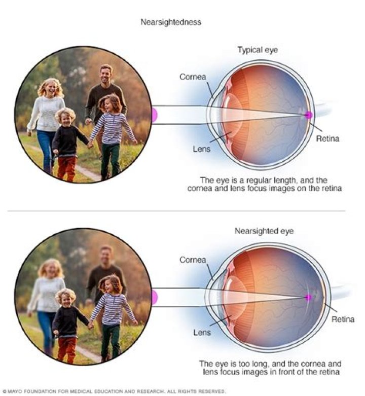 When is nearsightedness severe?