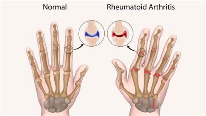 Where is rheumatoid arthritis most common?