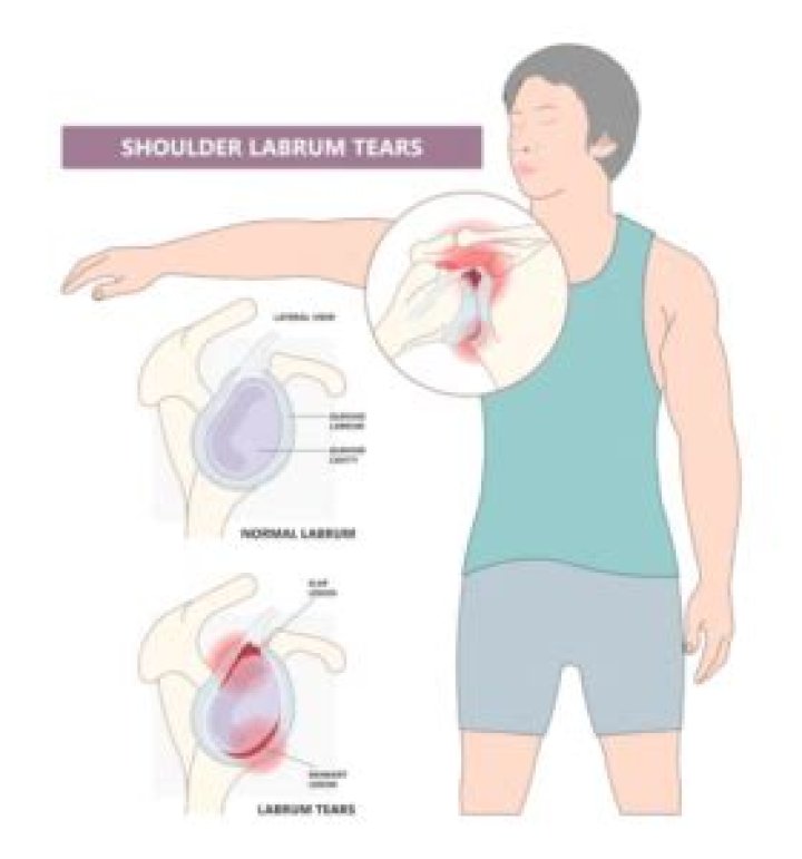 Where is the pain with a torn shoulder labrum?