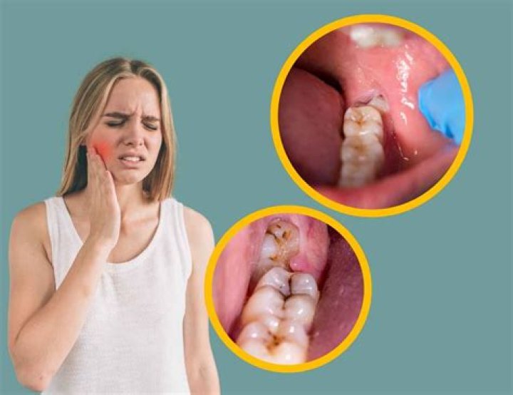 Where is wisdom tooth pain?