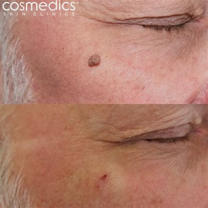 Where to remove papilloma?