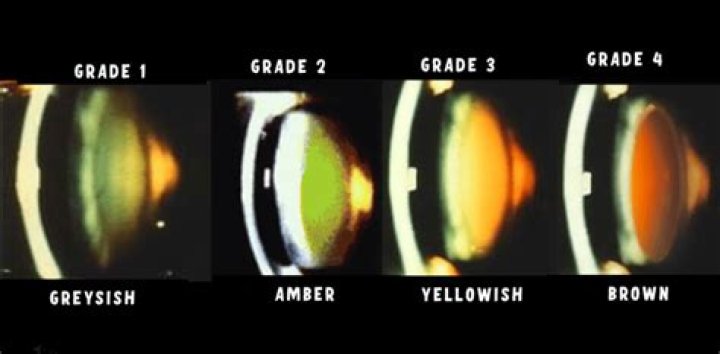Which is lens opacity?