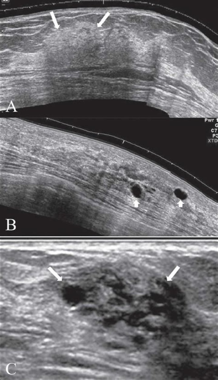 Which of the following refers to fibrocystic breast disease?