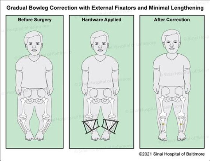 Why are dwarfs bow legged?