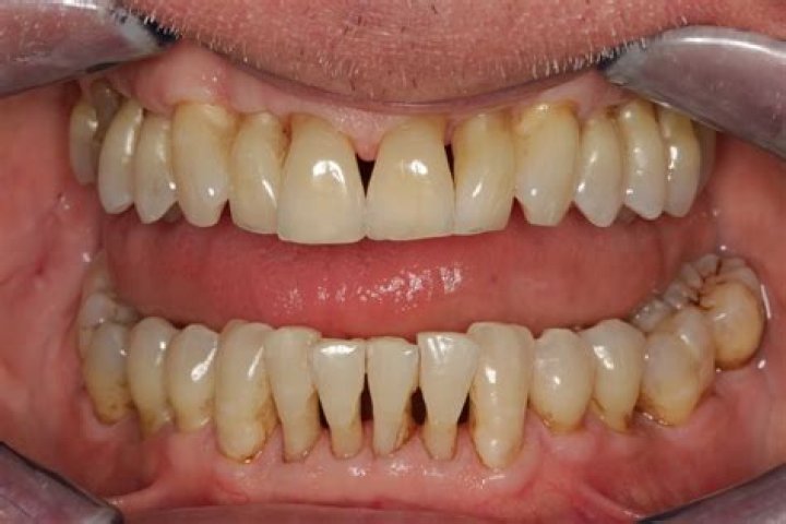 Why are my gums receding so badly?