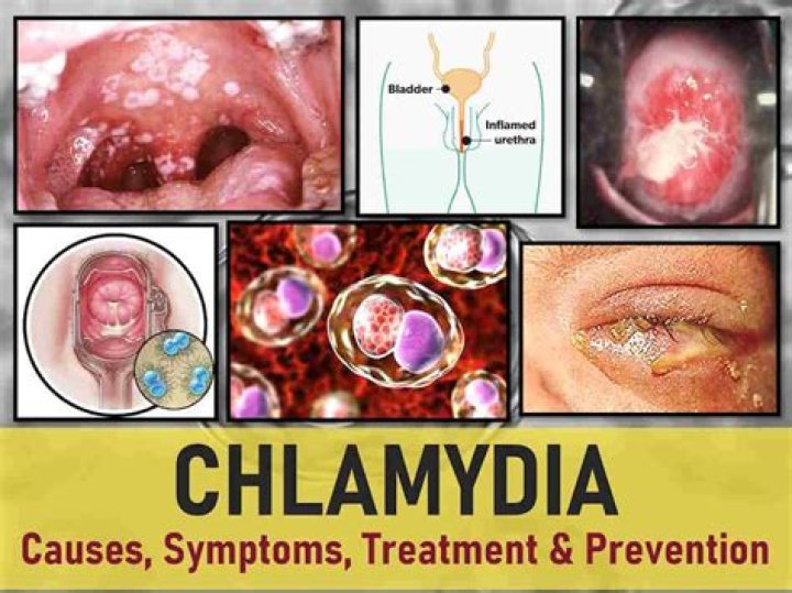 Why do you get chlamydia?