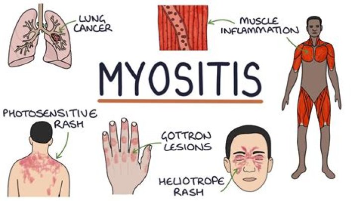 Why do you get myositis?