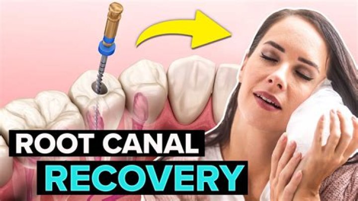 Will a root canal hurt after?