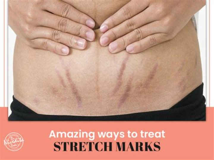 Will belly stretch marks go away?