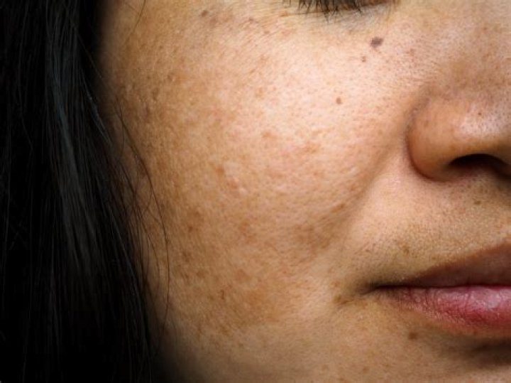 Will chloasma go away?