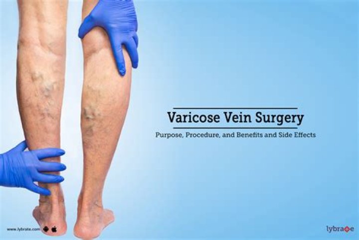 Will varices go away?